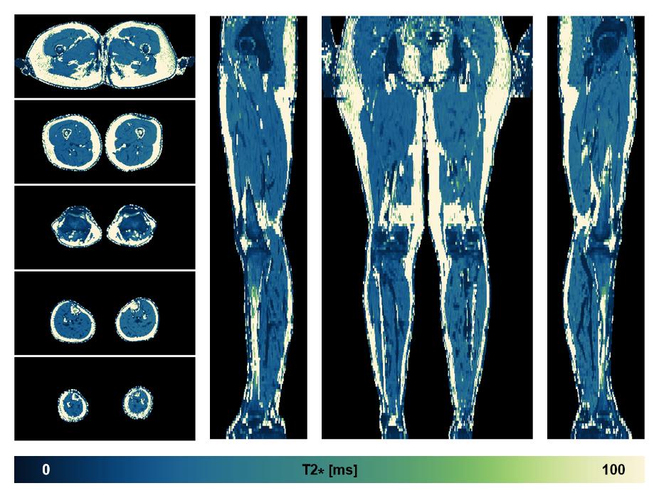 The T2 star relaxation time of the lower extremity obtained from the dixon reconstruction for muscle water fat quantification.